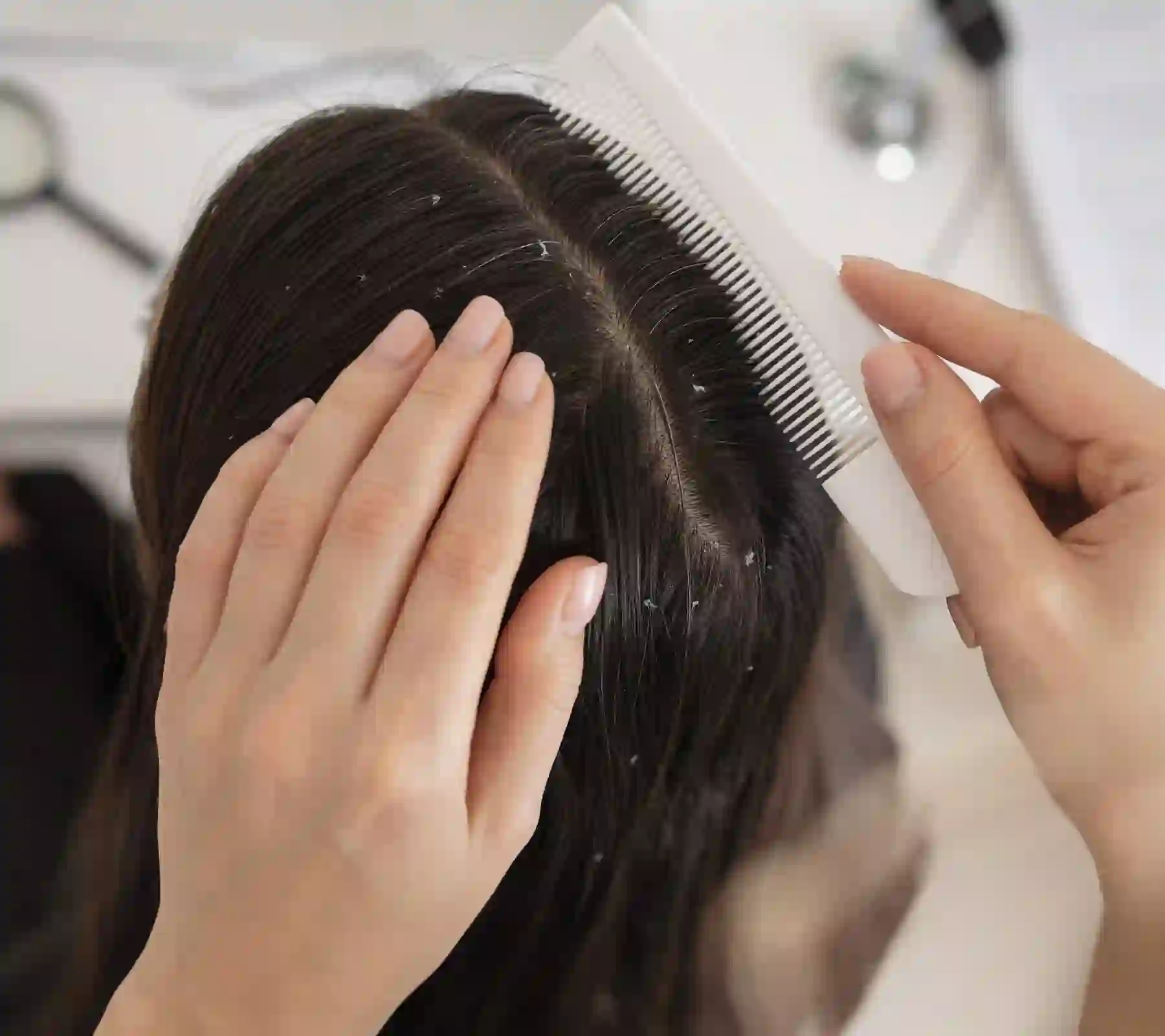 Dandruff